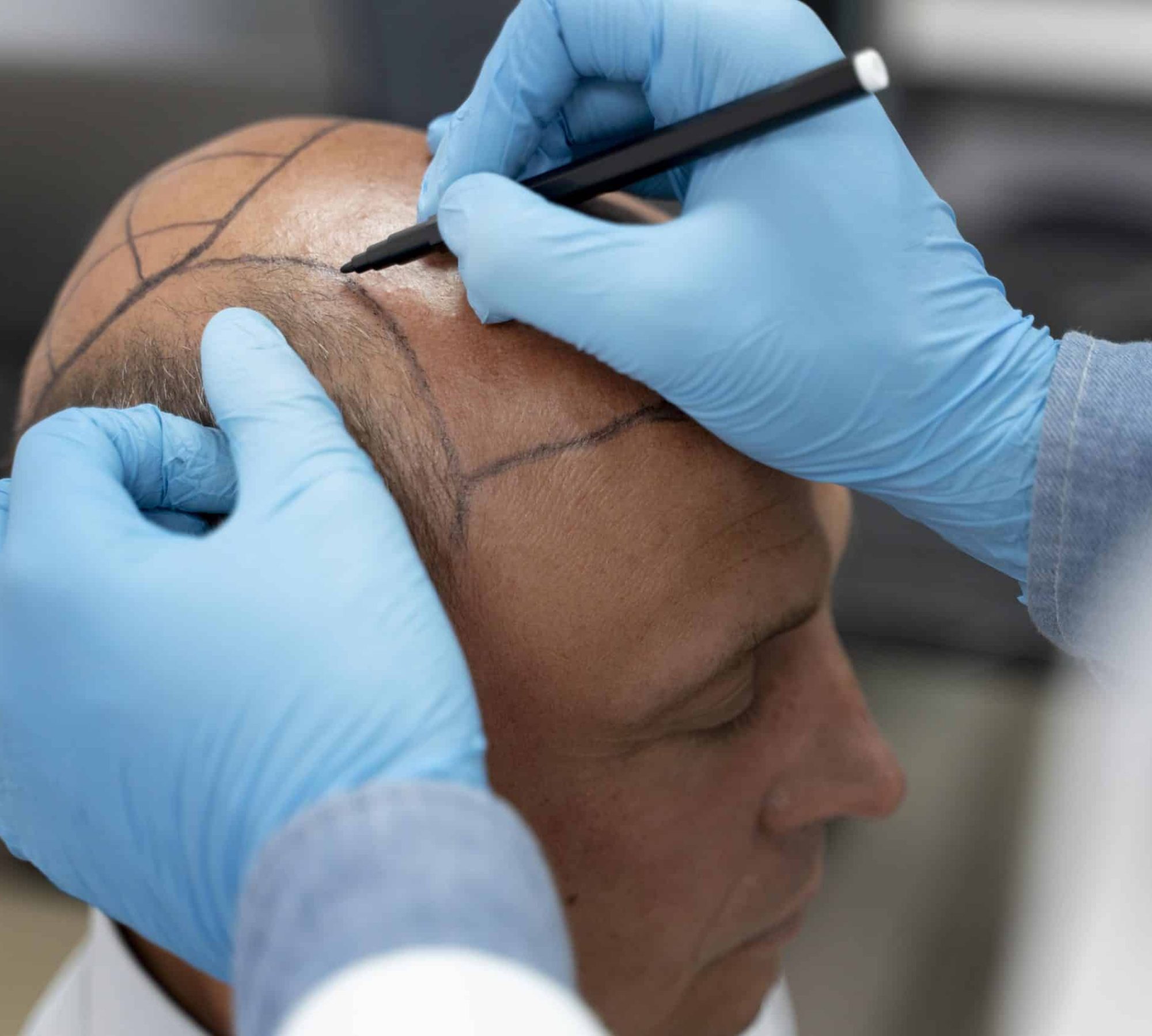 male-going-through-follicular-unit-extraction-process (1)