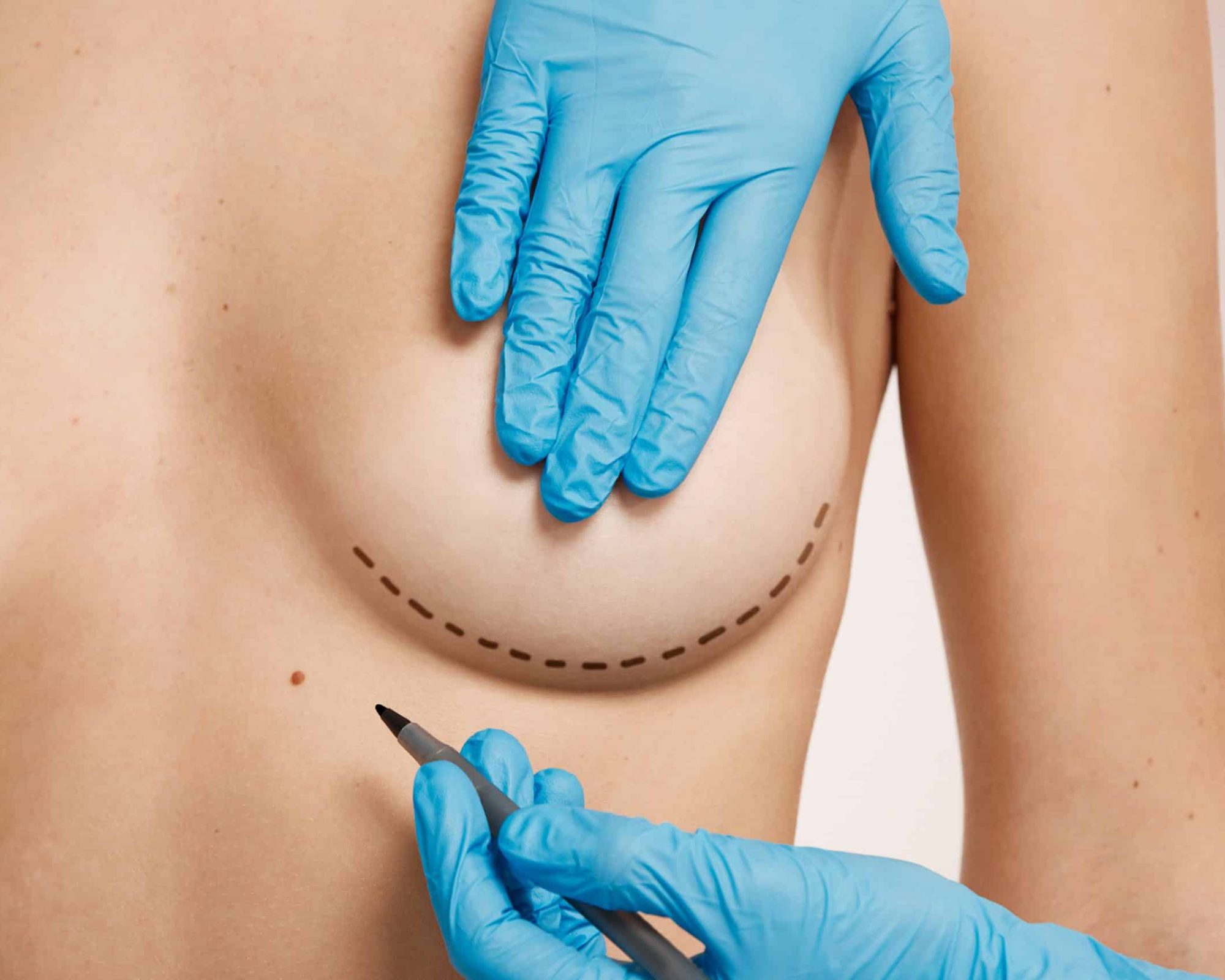 Beautiful woman with plastic surgery, depiction, plastic surgeon hands. Cosmetic surgery concept