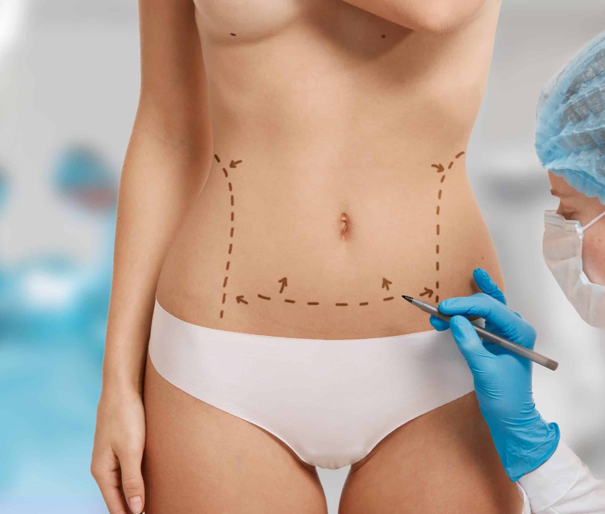 Plastic surgery doctor draw line on patient breast augmentation implant. Woman belly marked out for cosmetic surgery in surgery room interior